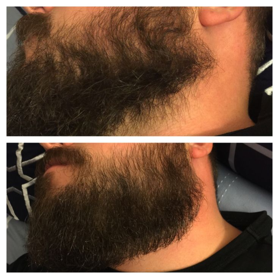 Dr. Alies Professional Beard Growth Oil | Natural Formula with Vitamin E, Almond Oil & Castor Oil