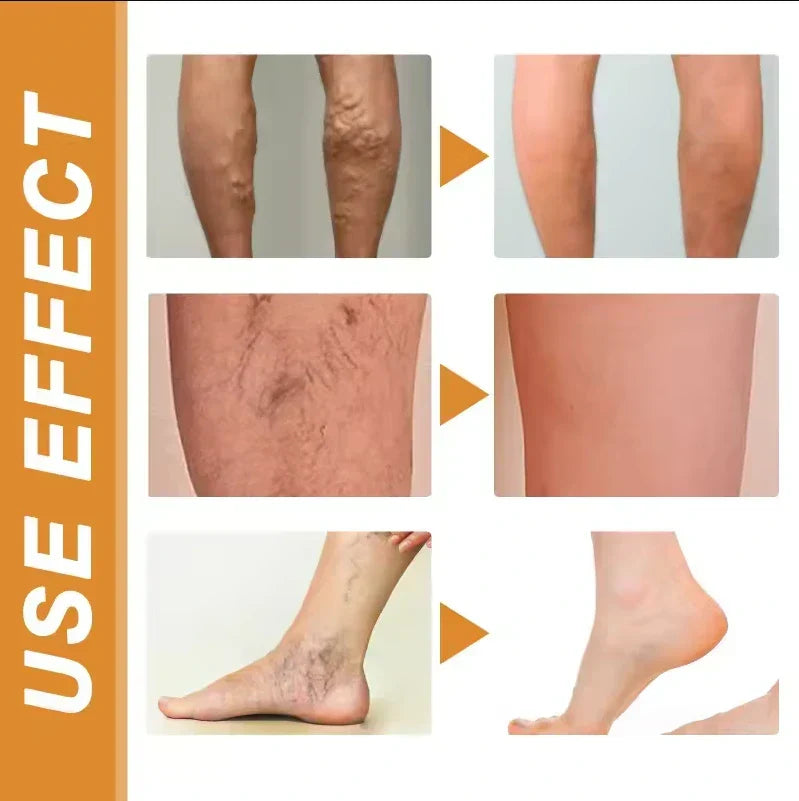 Turmeric Vericose Vein Relief Spray