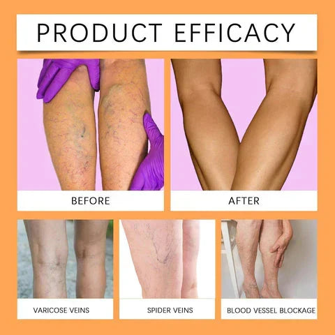 Turmeric Vericose Vein Relief Spray
